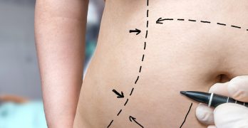 My Doctor’s Refusal To Give Me Liposuction Was A Blessing In Disguise